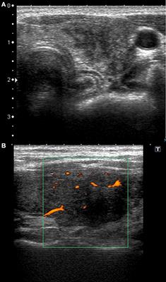 ultrasound findings subacute thyroiditis)